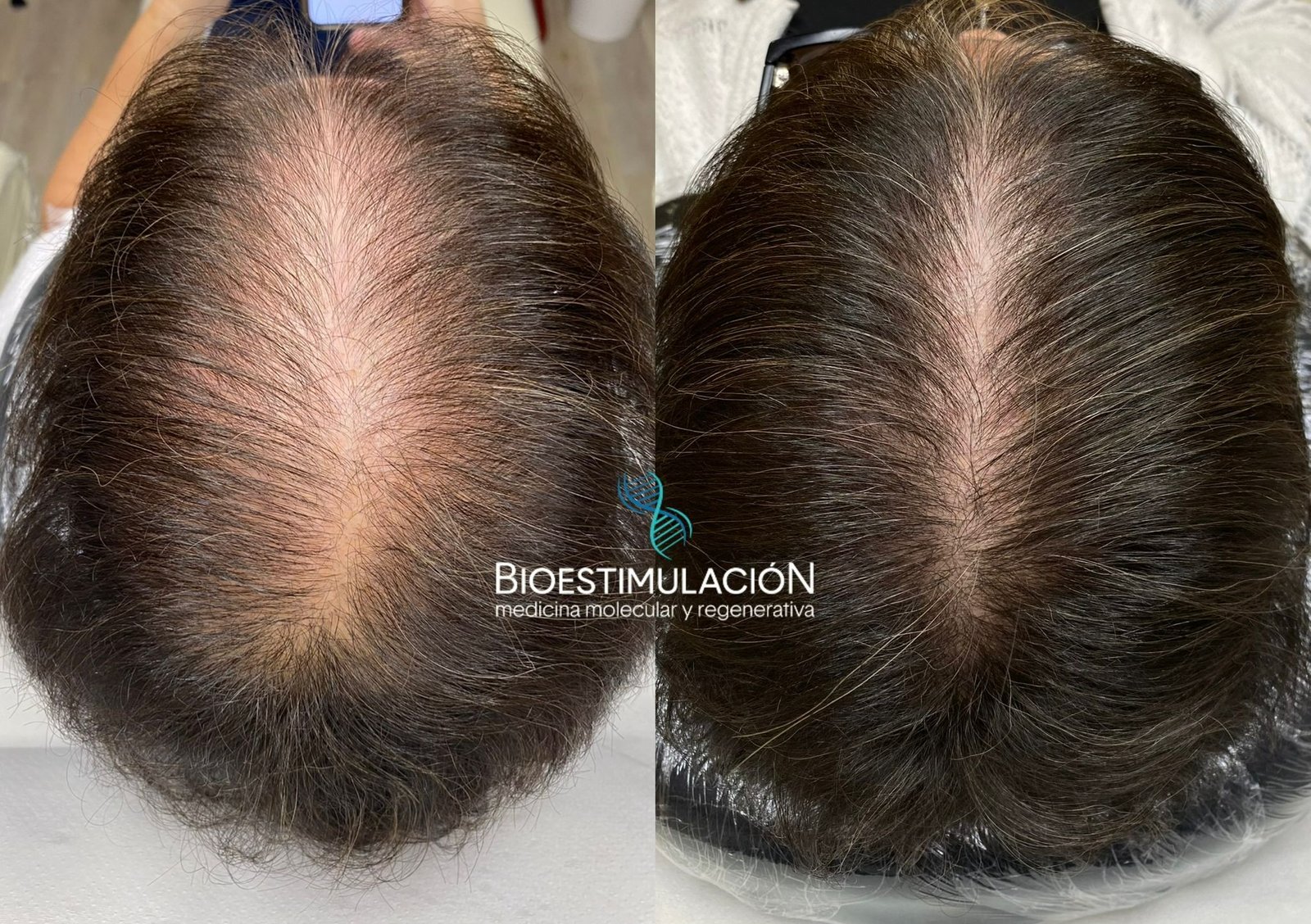 Resultado de recuperación capilar - Bioestimulación